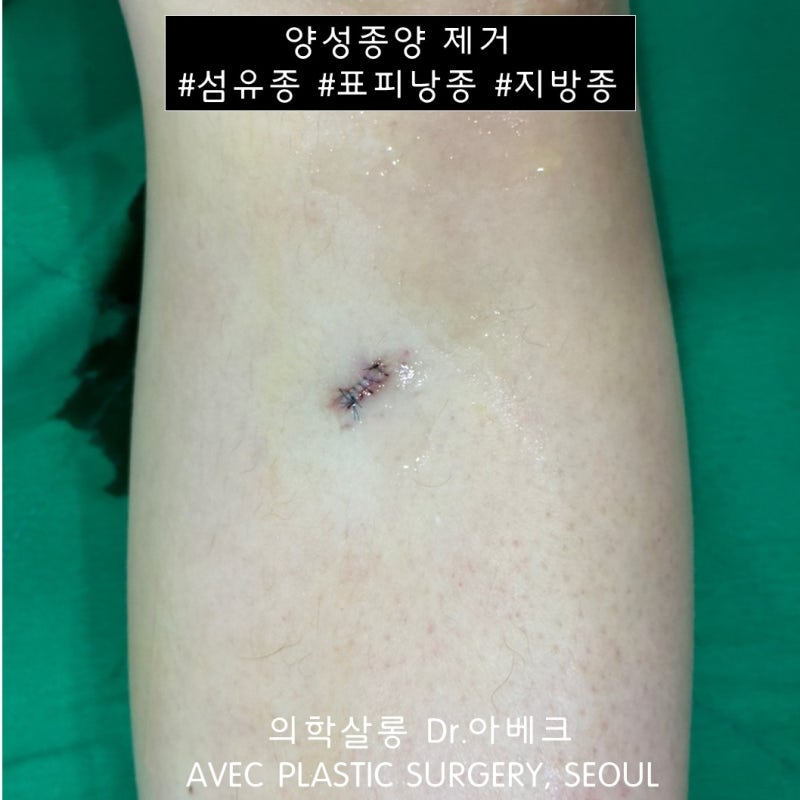 피부섬유종 제거 사례 (종아리) 【Dr. 아베크 양성종양】 : 네이버 블로그