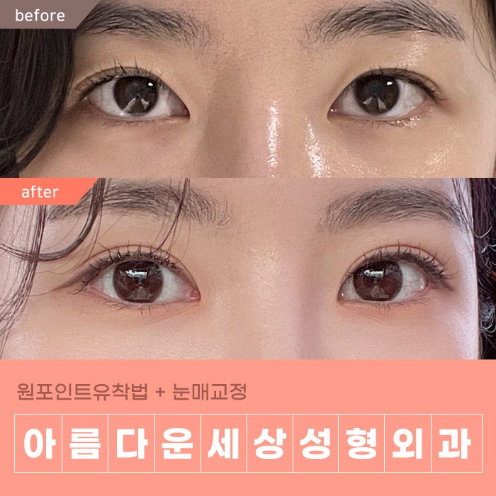 비절개눈매교정 붓기,회복기간,비용,흉터 자세히 알려드릴게요.