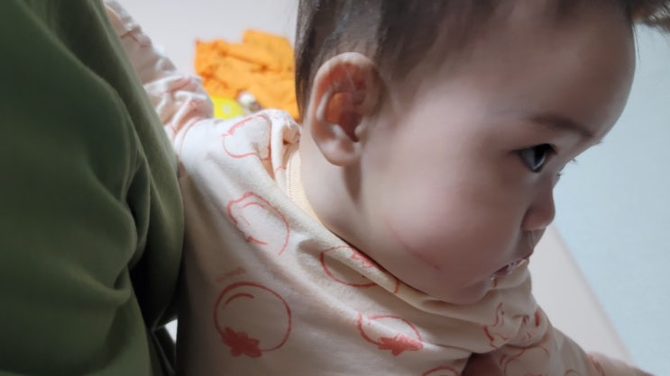  우리 아기 얼굴에 손톱으로 인한 상처(흉터) 제거용 재생연고(마데카솔) 발랐어요 효과는