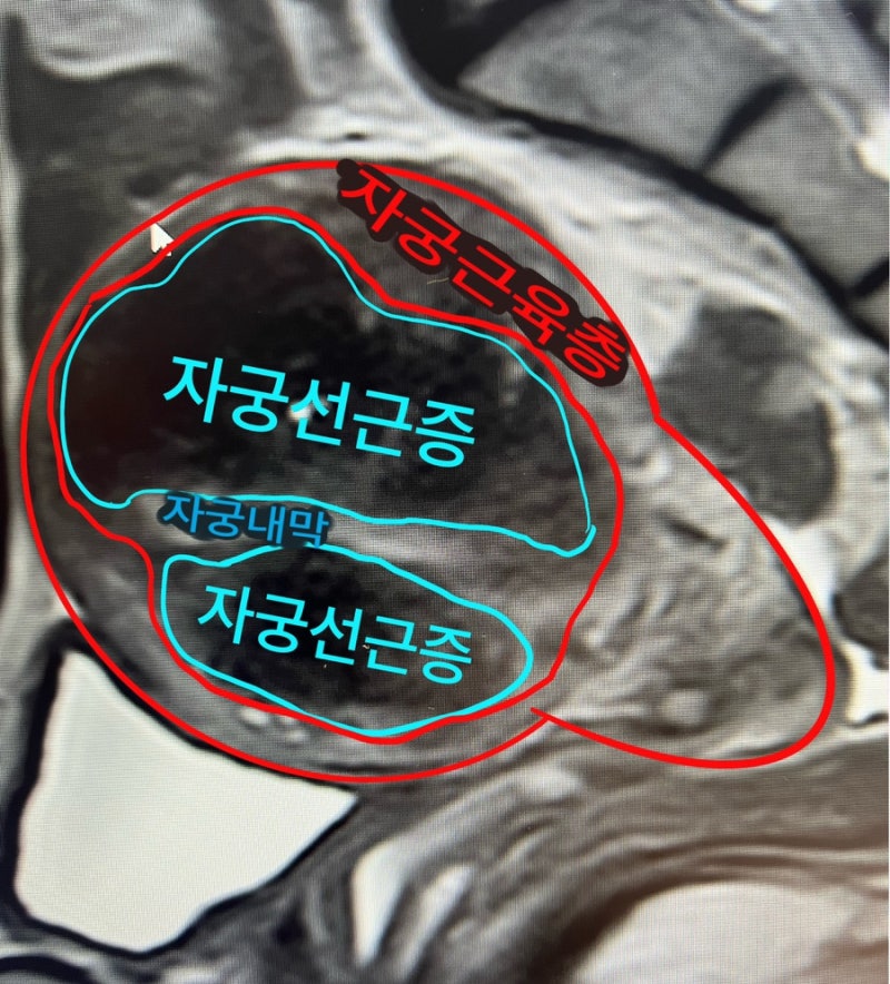 자궁선근증 하이푸 치료과정