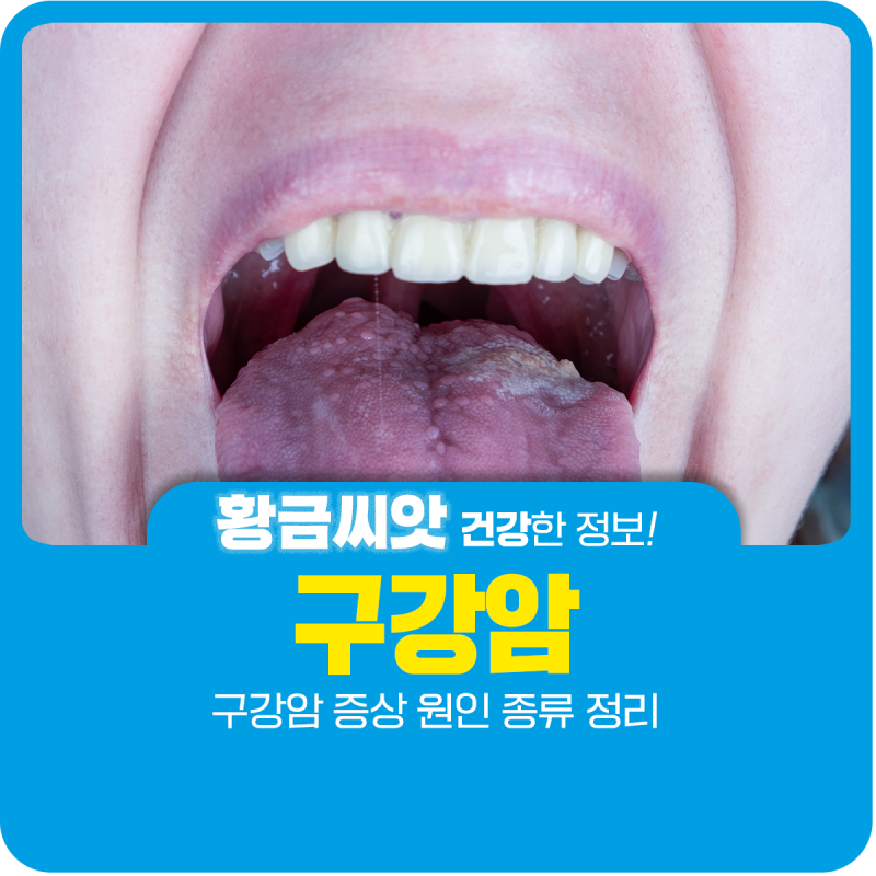 구강암 증상 원인 종류 정리