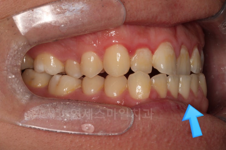  주걱턱 비수술 교정만으로 해결 후기 (유전? 치료기간, 치료방법) 노원교정치과