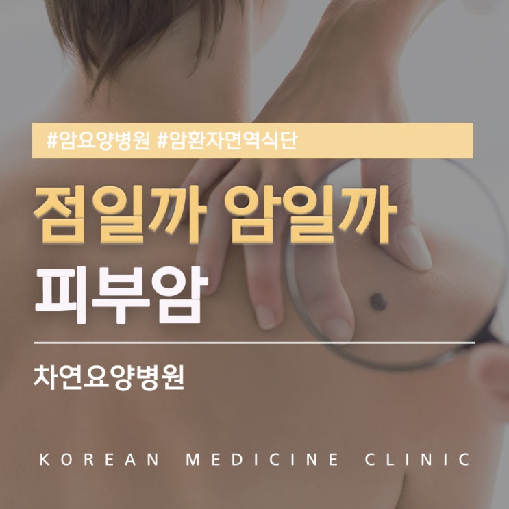  피부에점 점일까, 암일까 피부암 구별하기