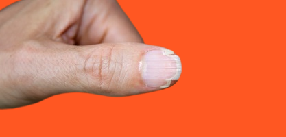 손톱 갈라짐 찢어짐 부서짐 원인 건강 회복방법