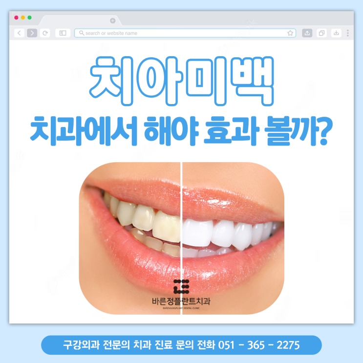  덕천치과 치아미백은 전문적으로 해야 효과를 본다?