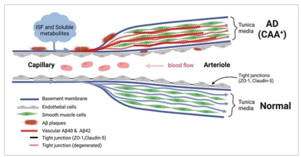  "혈액-망막 장벽 손상은 치매 예고 신호" Study: Blood Vessel Damage Could Be an Alzheimer’s Driver