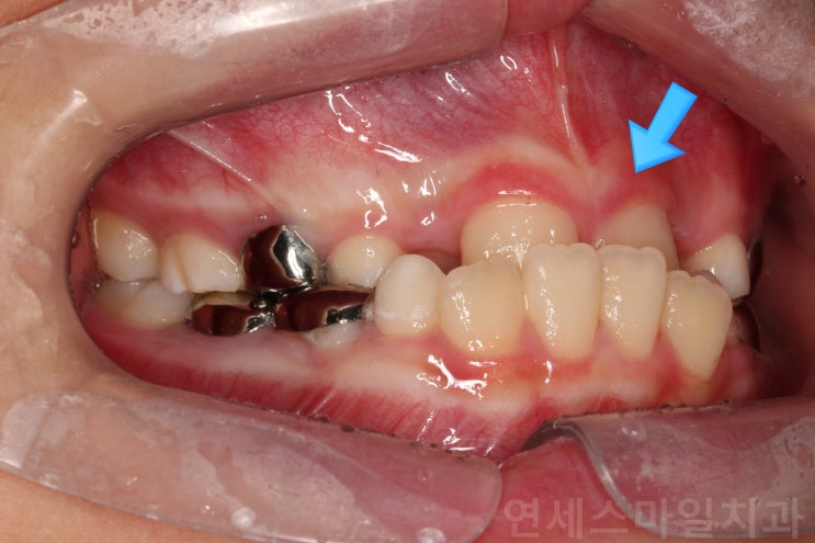  교정과 전문의가 말하는 어린이 주걱턱 교정, 교정시기가 가장 중요 (노원치아교정)