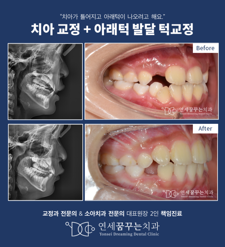 눈에 잘 보이지 않는 골격 문제, 어린이 턱교정으로 바른 얼굴 만들기