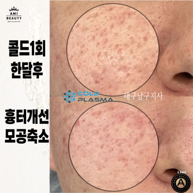  대구여드름흉터, 패인여드름흉터로 인한 스트레스 해결 방법!
