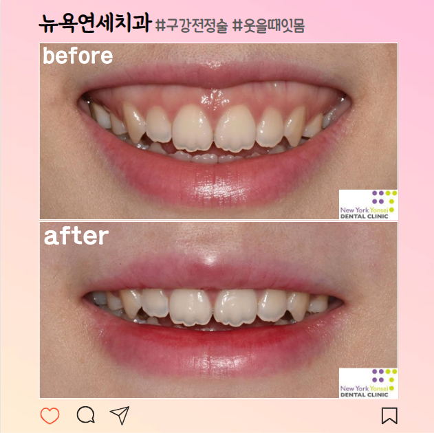  [강남역 잇몸성형] 과한 잇몸때문에 스트레스 받는 거미스마일, 후기로 알아보는 해결방법(feat.구강전정술, 입술재배치술)