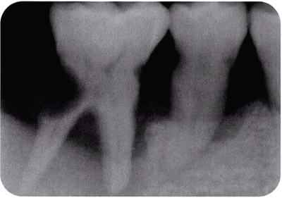 충치가 있는 치아는 x-ray에서 어떻게 보일까? 충치 진단 - 치아우식과 치과방사선사진