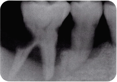  충치가 있는 치아는 x-ray에서 어떻게 보일까? 충치 진단 - 치아우식과 치과방사선사진