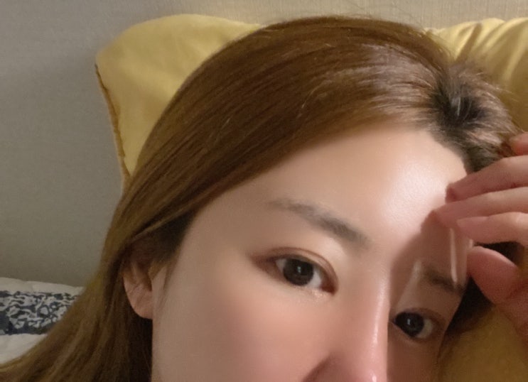  접촉성 모낭염 주사 지루성 피부염 스테없이 셀프 치료로 90% 완치
