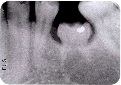 매복치, 침하치, 만곡치, 왜소치, 과잉치 - 치아교정에 영향을 주는 치아들 방사선영상 X-ray