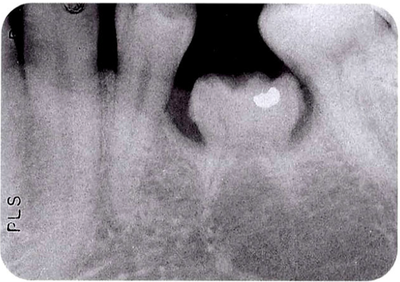 매복치, 침하치, 만곡치, 왜소치, 과잉치 - 치아교정에 영향을 주는 치아들 방사선영상 X-ray