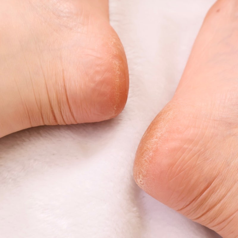 올영세일 추천템 마데카 발필링팩 발각질 고민 없애주는 발관리템 영양 보습까지 한번에 : 네이버 블로그