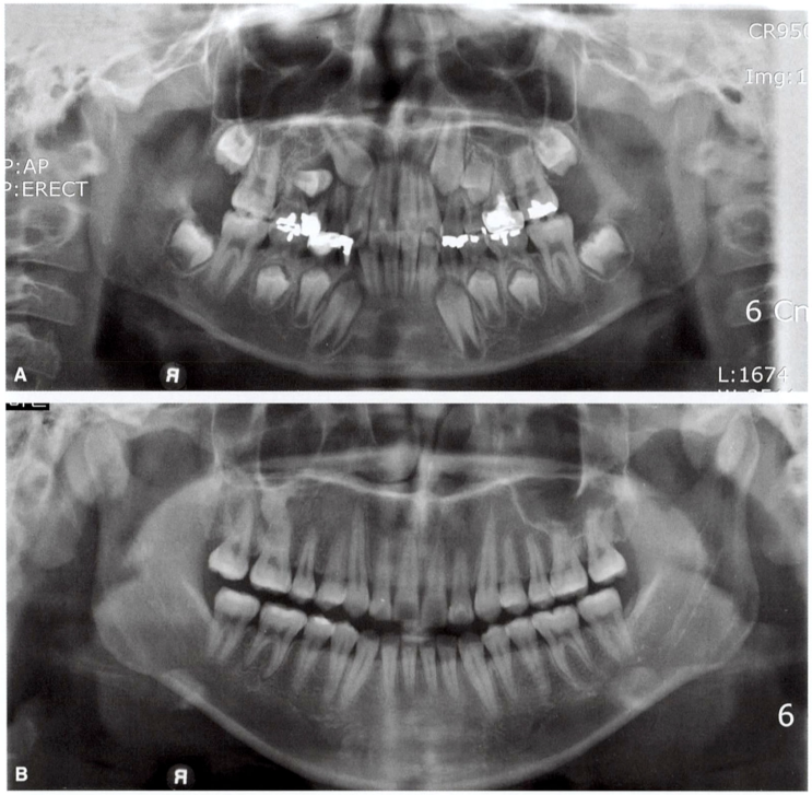 치과 파노라마 사진이 뭐에요? 파노라마 방사선 사진 / Panorama X-ray / Orthopan