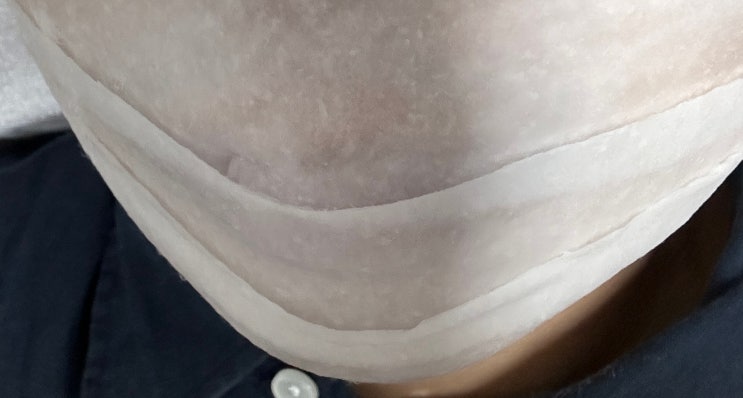  남자 안면 레이저제모(인중,턱,목),3회차 후기,통증,사진