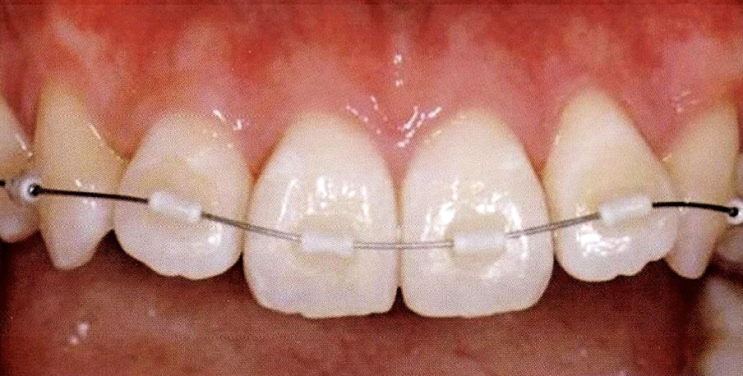 MTM : Minor Tooth Movement 란? 최소교정법, 부분교정, 미니교정, 마이너교정, 미니멀교정