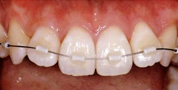  MTM : Minor Tooth Movement 란? 최소교정법, 부분교정, 미니교정, 마이너교정, 미니멀교정