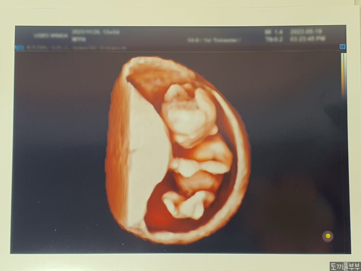 [임신일기] 12주~13주 : 1차 기형아 검사 / 첫 입체 초음파 / 디클렉틴 지르텍정 데스오웬 처방 / 임산부 갑상선 호르몬 저하증