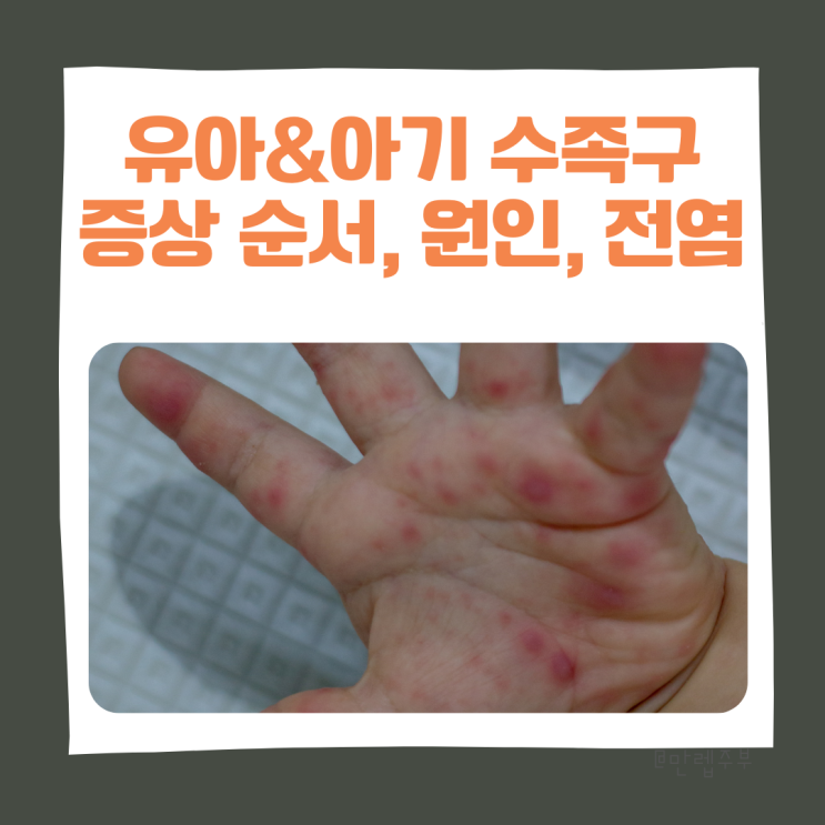  유아 & 아기 수족구 증상 및 원인 , 초기증상 순서, 전염기간