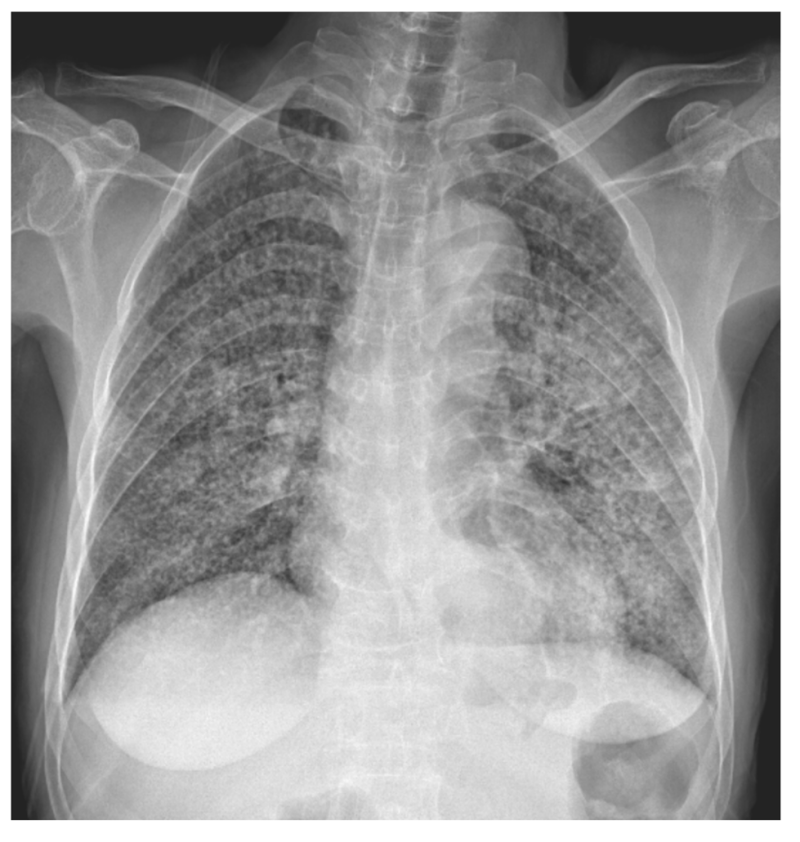 활동성 폐결핵 폐엑스레이 증례, 속립 결핵, 폐경화, 결핵종, x-ray : 네이버 블로그
