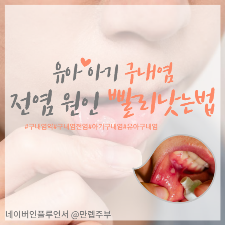 유아 아기 구내염 전염 빨리낫는법 원인 증상 및 입병 약 까지 !