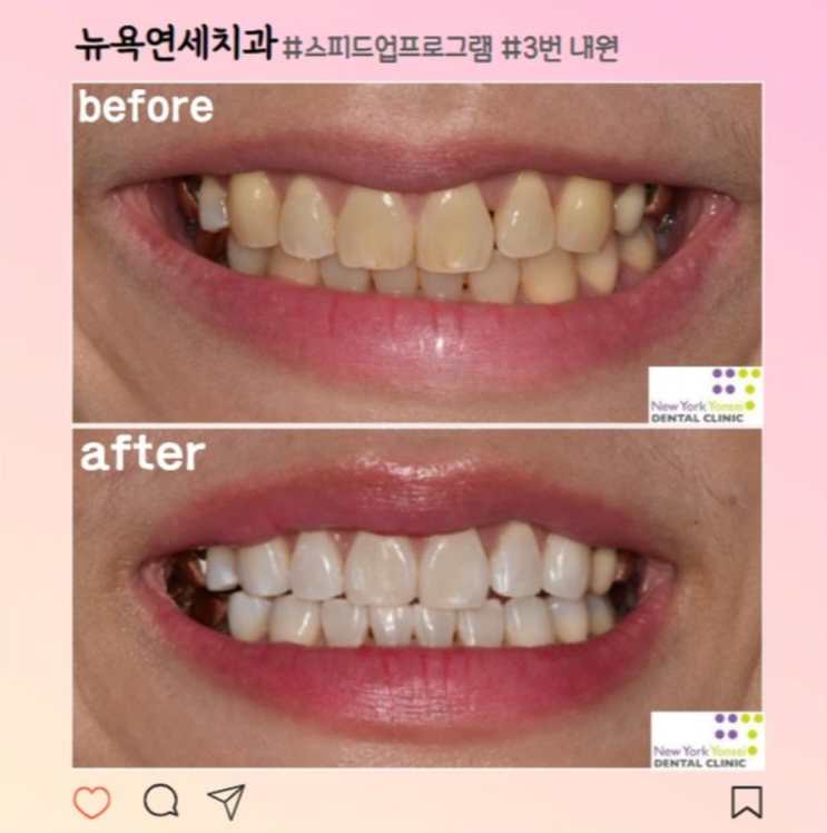 [강남역 치아미백] 단기간에 환한 치아 만드는 방법