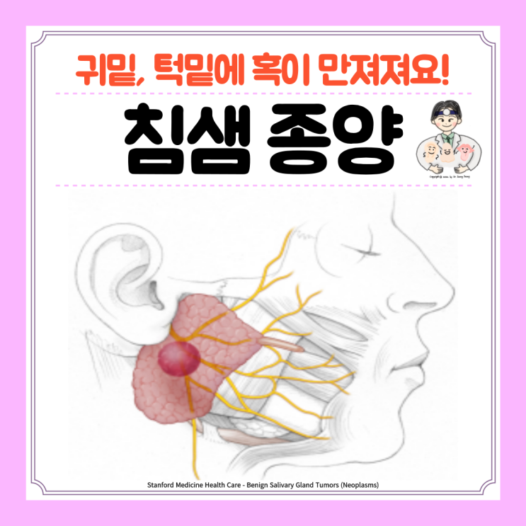  침샘 혹 귀밑 턱밑 멍울 악하선 이하선 종양 원인 증상 수술 절제술