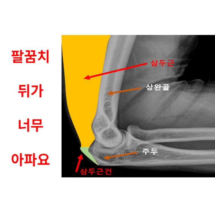  삼두근건염, 팔꿈치 뒤가 너무 아파요
