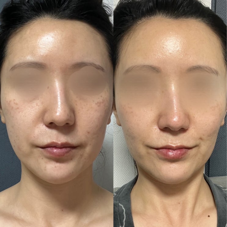  [홍대] 오타모반 레이저 치료 5회차까지 후기 - 내돈내산