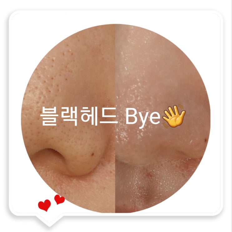  영원히 블랙헤드와 안녕하고 싶다 ㅠㅠ 블랙헤드 없애는 방법!