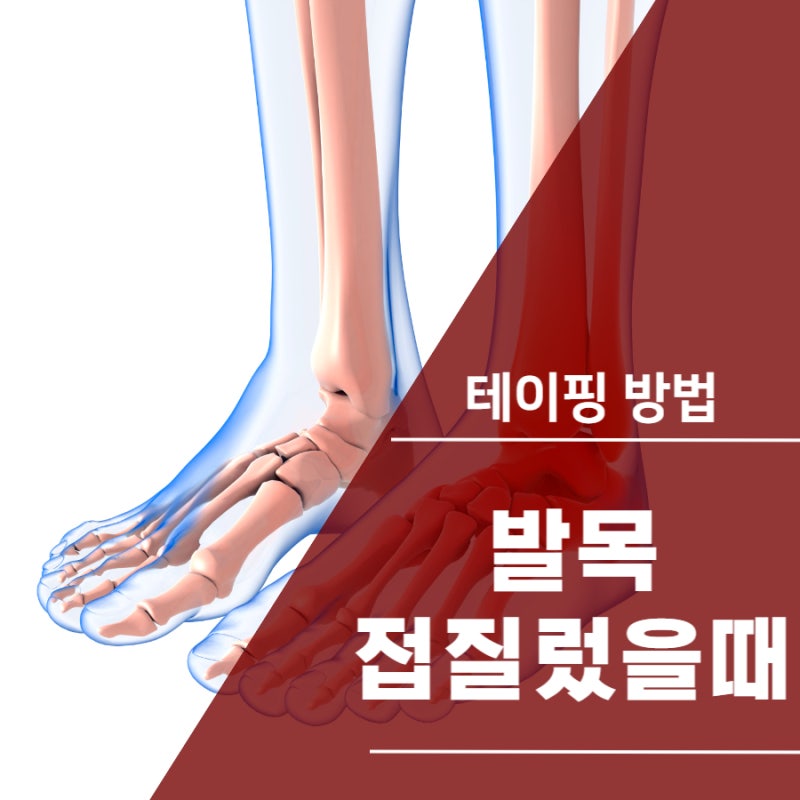 발목 접질렀을때 테이핑 꿀TIP!