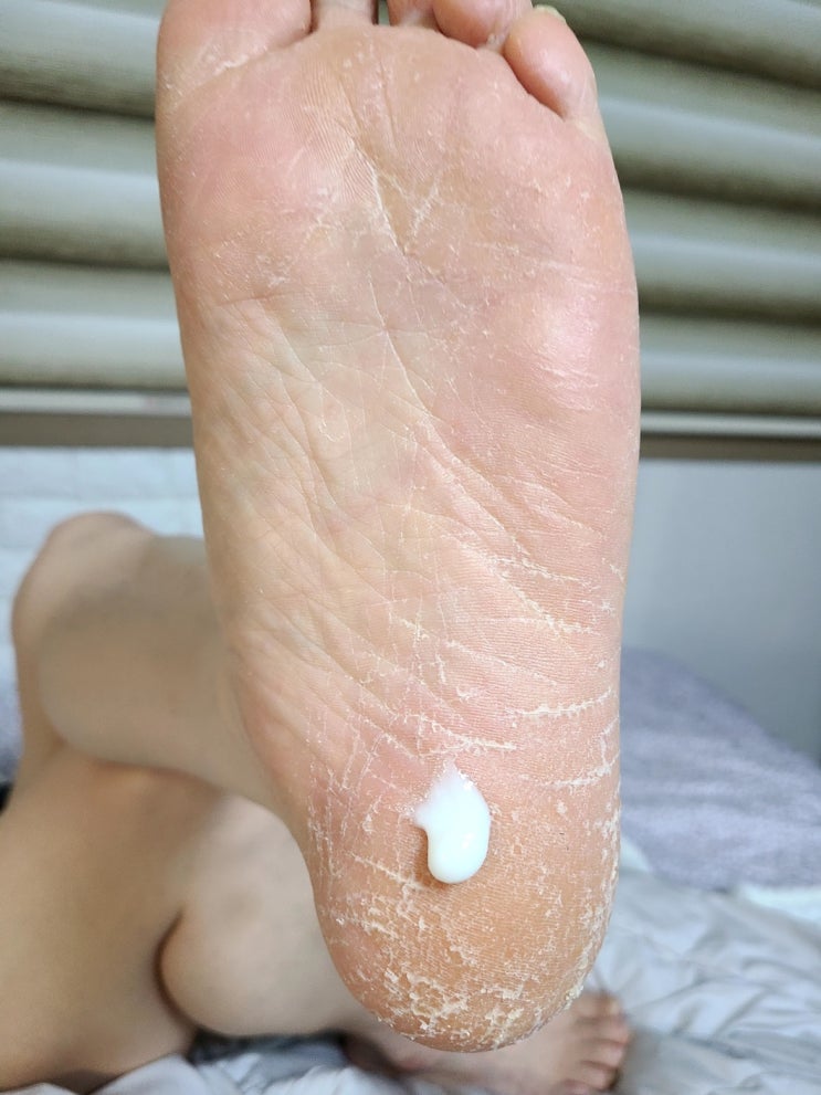  발각질제거 크림 사용 16일차 신랑이 흥분했어요