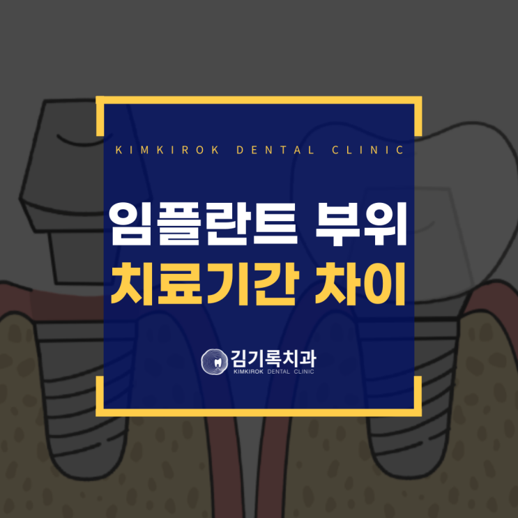 수원오스템임플란트 위턱과 아래턱 임플란트 치료 기간 차이는