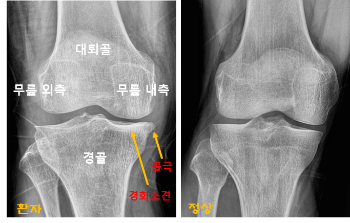  광주 무릎수술, 나이 때문에 못한다면?