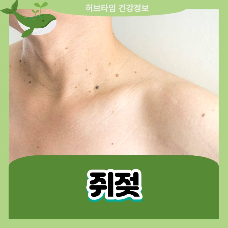 쥐젖 원인 목 쥐젖 제거 연고 정보정리 : 네이버 블로그