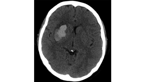 [ NS, 신경외과 ] 뇌출혈의 종류 #5. IVH Intra Ventricular hemorrhage 뇌실내출혈 / ICH ...