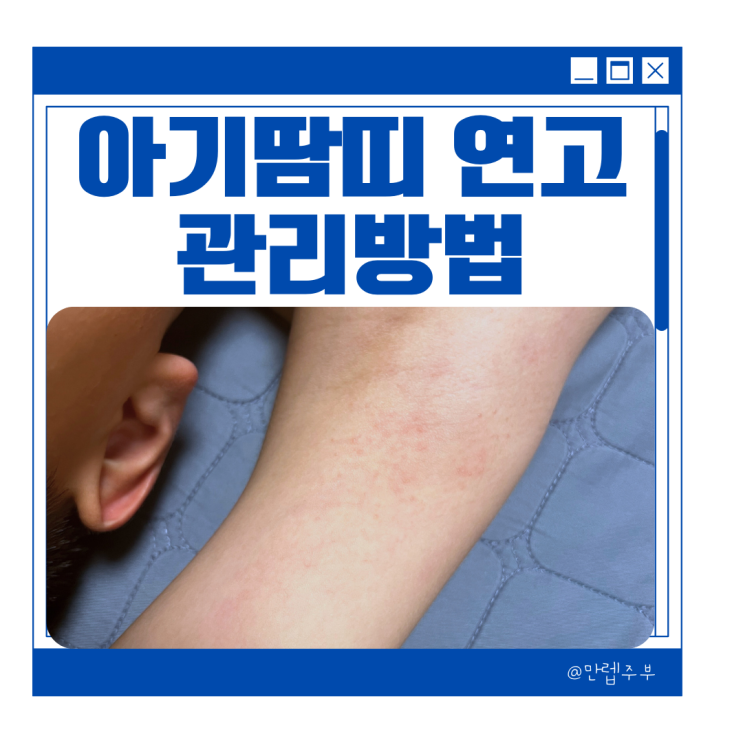  유아 & 아기 땀띠 연고 , 땀띠없애는법 팁 광고X