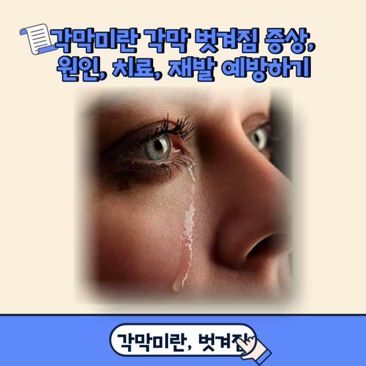  각막미란 각막 벗겨짐 증상, 원인, 치료, 재발 예방하기