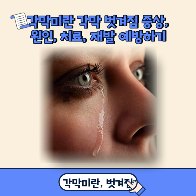 각막미란 각막 벗겨짐 증상, 원인, 치료, 재발 예방하기