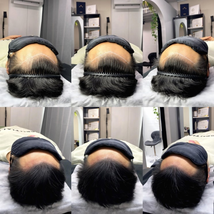  서울smp 두피문신 엠자탈모커버 성공 찐후기