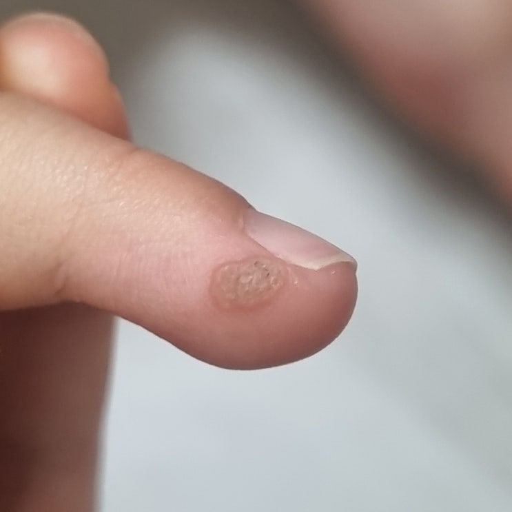 7살 아이 손 사마귀 냉동치료 및 완치 후기