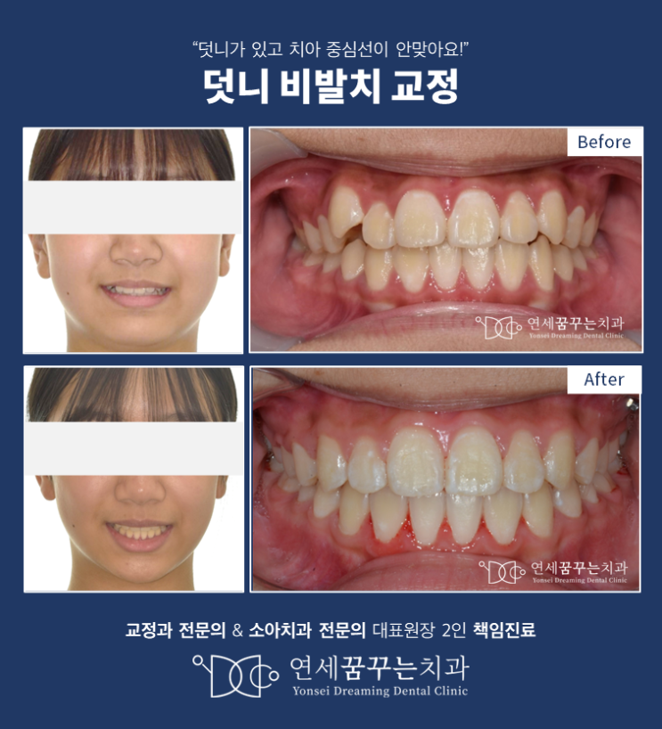 발치 없이 덧니 교정이 가능한 경우가 언제일까? 발치 없이 덧니 교정이 가능한 경우가 언제일까?