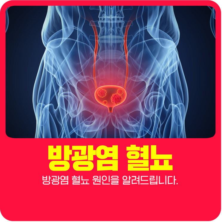  방광염 혈뇨 원인을 알려드립니다.