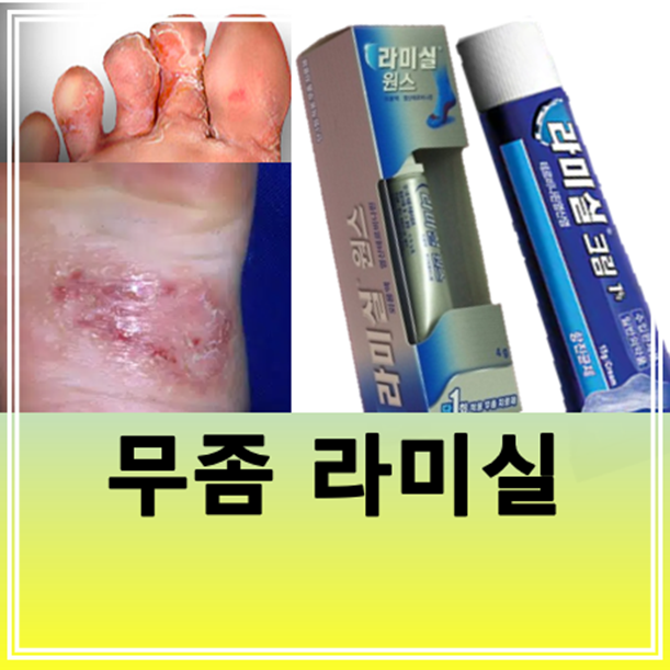 라미실원스, 라미실 크림 연고 가격 사용법(발바닥, 발가락 무좀약) : 네이버 블로그
