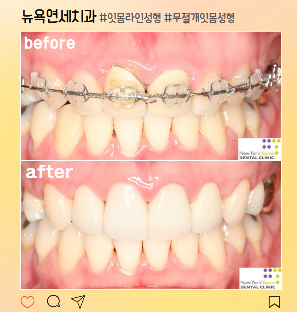  [강남역 잇몸성형] 교정 후 해결되지 않는 거미스마일? 무절개 잇몸성형으로 해결!
