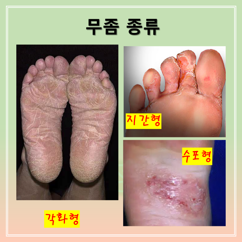 라미실원스, 라미실 크림 연고 가격 사용법(발바닥, 발가락 무좀약) : 네이버 블로그