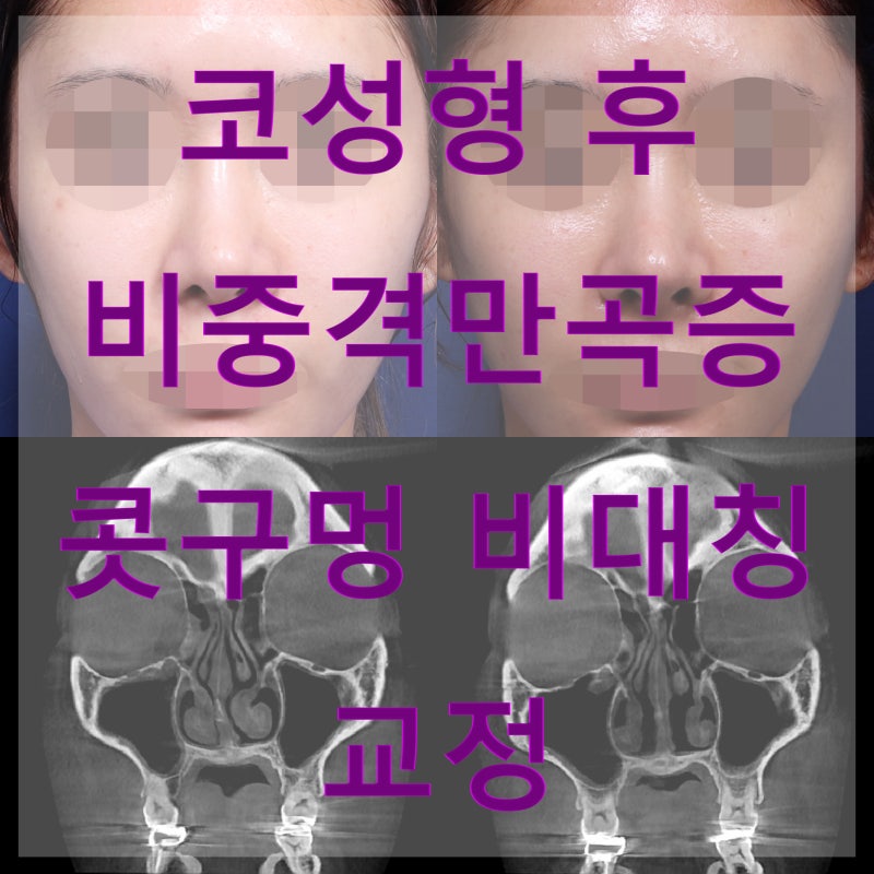 코성형 후 생긴 비중격만곡증, 콧구멍 비대칭 교정